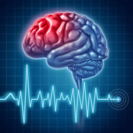 مهم ترین نشانه های سکته مغزی را بشناسید